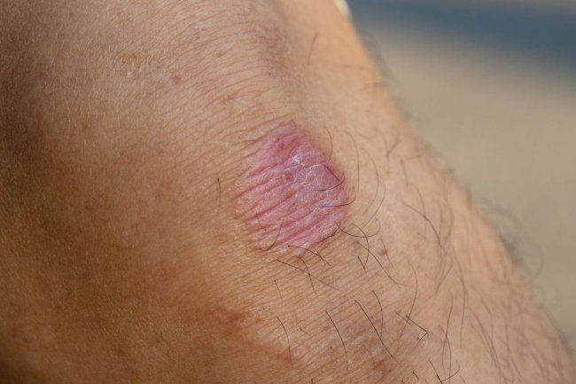 CDC: Highly Contagious, Drug-Resistant Ringworm Reported In U.S. For First Time