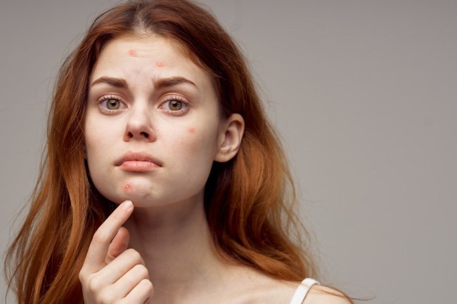 13 Best Acne Spot Treatments to Dramatically Improve Pimples Overnight