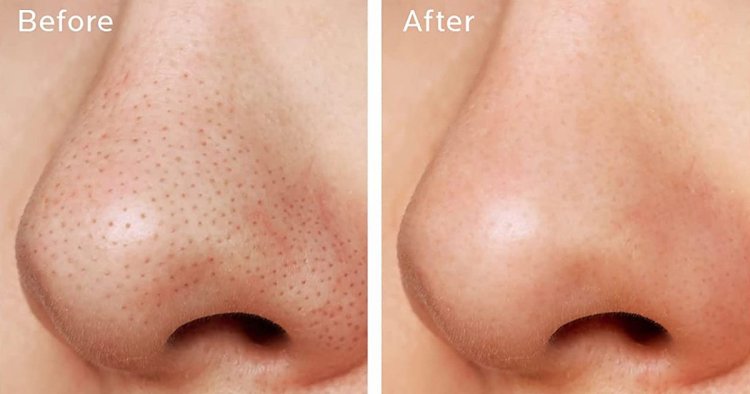Strawberry Nose? This 3-Step Pore Kit Is Dissolving Blackheads — 20% Off!