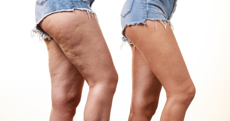 This $11 Anti-Cellulite Cream Is a Secret Hit on Amazon
