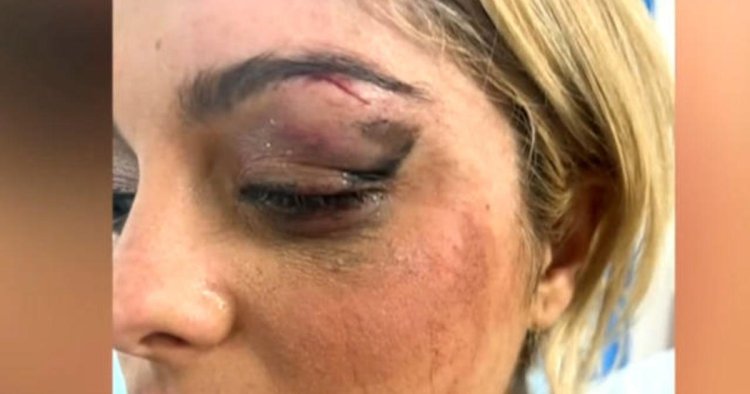 Pop star Bebe Rexha hit in face with cell phone during concert