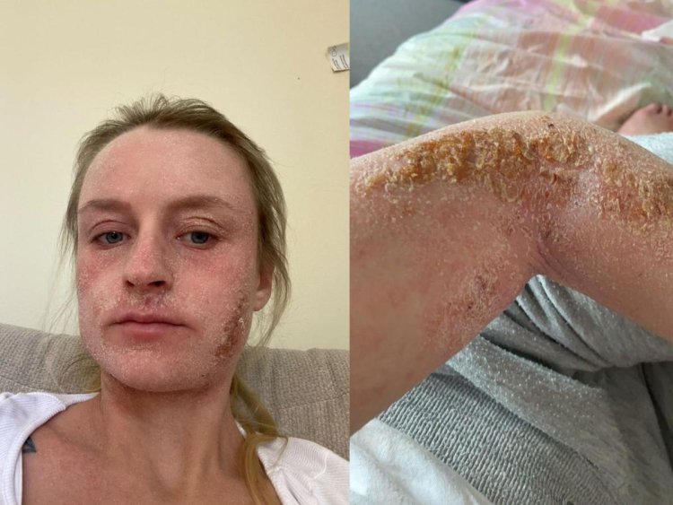 A 25-year-old ended up bedbound and covered in scabs from a skin condition that some doctors don't believe exists