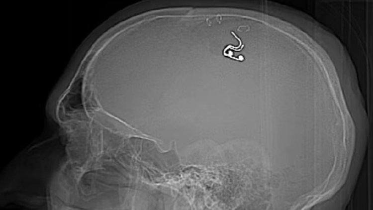 俄罗斯男子为控制梦境给脑袋钻孔，在大脑植入芯片，4小时手术失血近1升