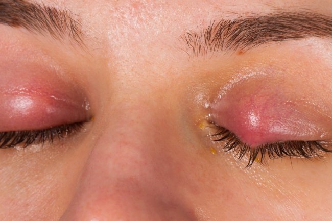 Tips to cure eye flu and prevent pink eye infection