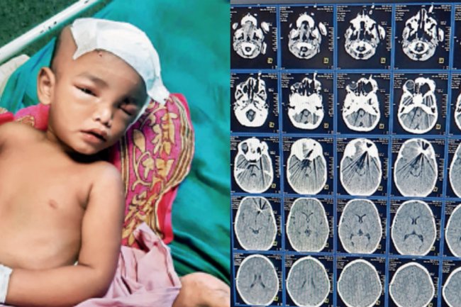 Docs save toddler's life after scissors pierce brain